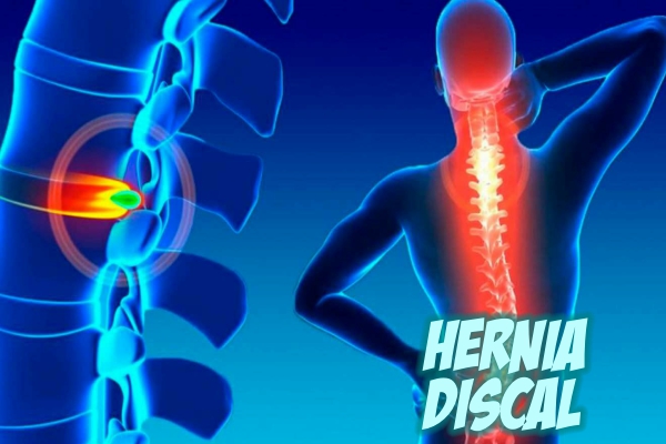 Hernia Discal Una Guía Completa Clinica Buena Vida 5050